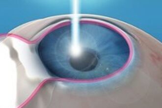 Lasik NJ at Diamond Vision