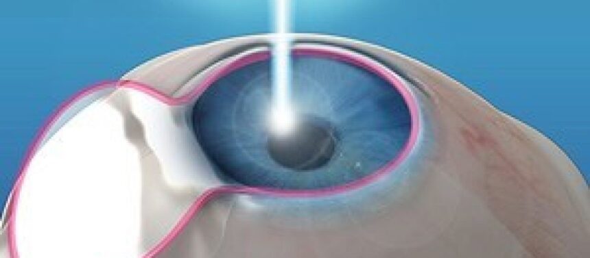 Lasik NJ at Diamond Vision
