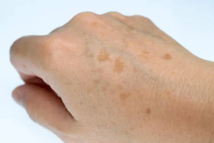 Spots