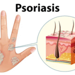 Psoriasis Treatment