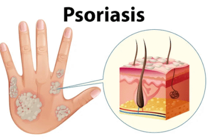 Psoriasis Treatment