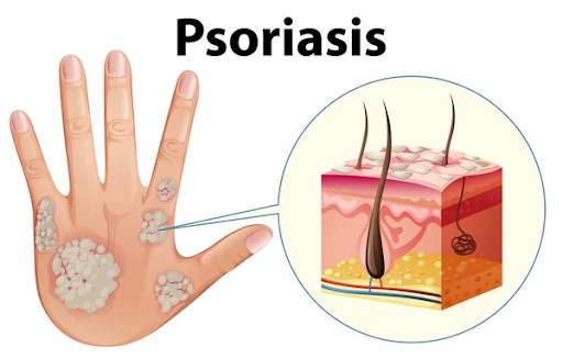 Psoriasis Treatment