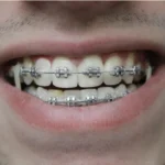 What to Expect When Getting Braces for the First Time