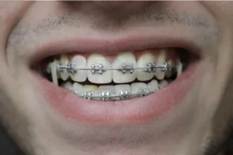What to Expect When Getting Braces for the First Time