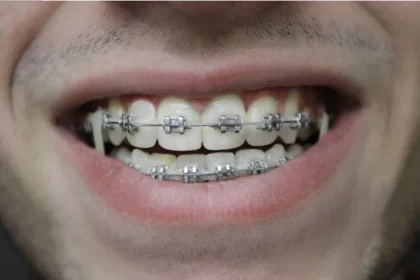 What to Expect When Getting Braces for the First Time
