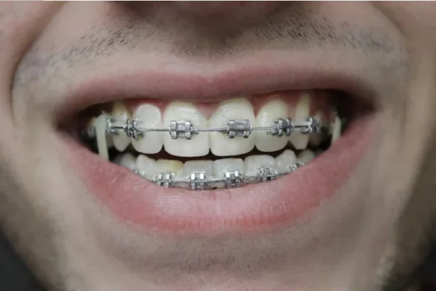 What to Expect When Getting Braces for the First Time