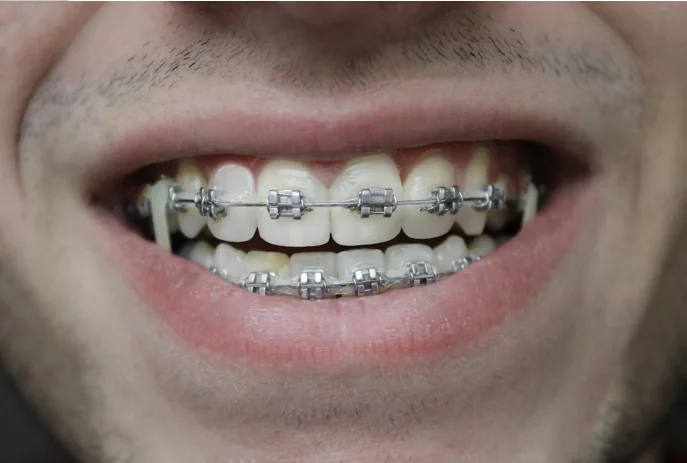 What to Expect When Getting Braces for the First Time